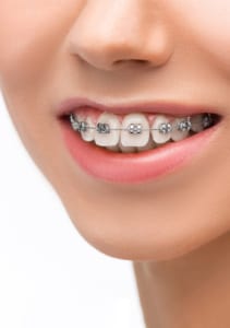 Điều trị chỉnh nha