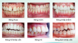 Những ai cần phải niềng răng