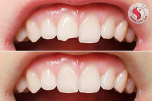 Làm răng sứ giá bao nhiêu ?